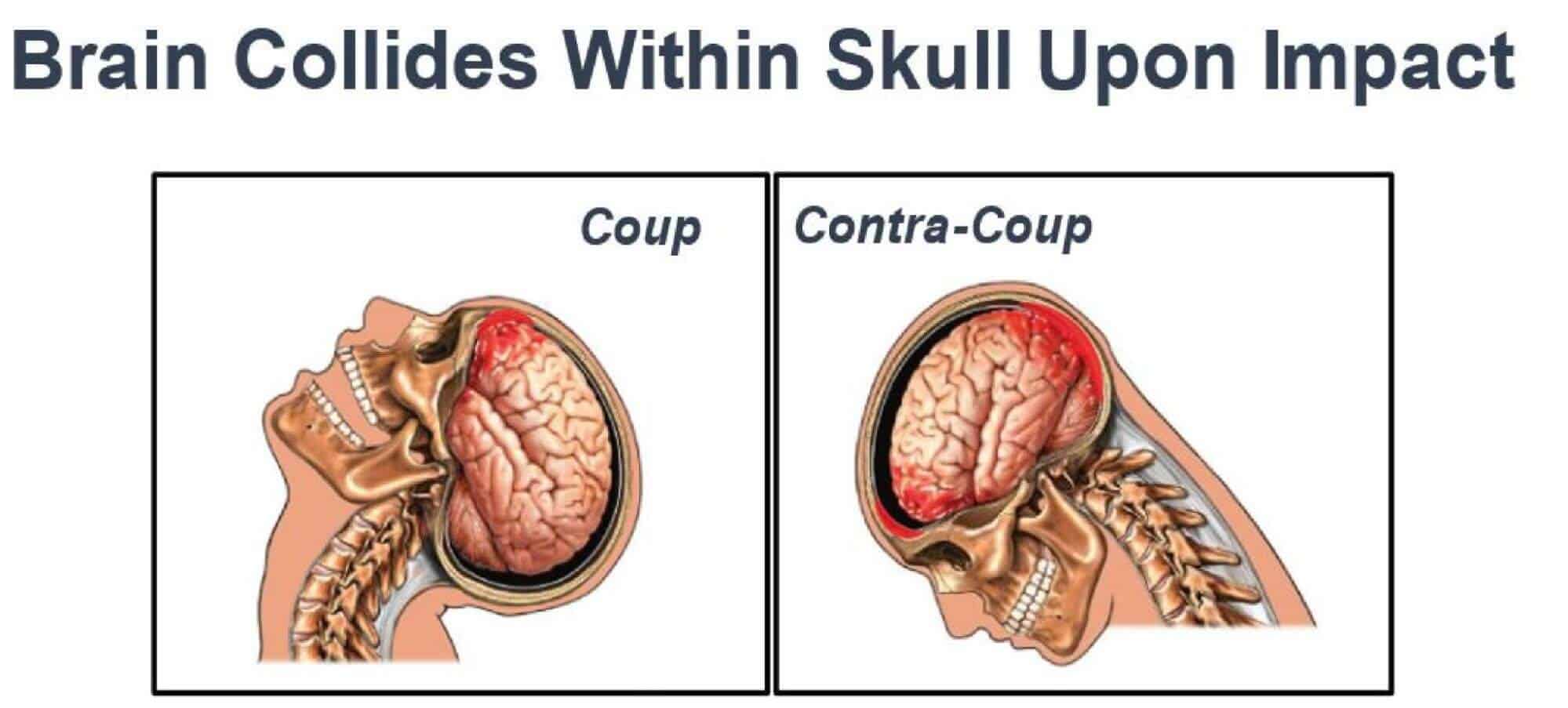 whiplash symptoms
